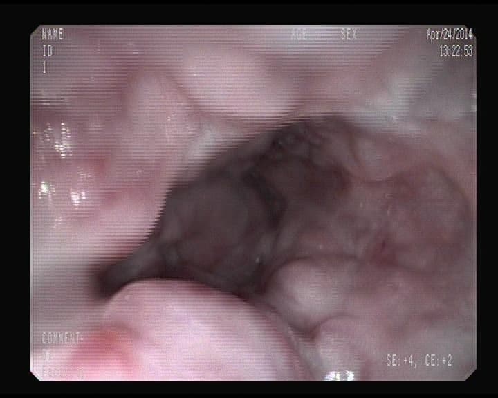 Varices Esofágicas.