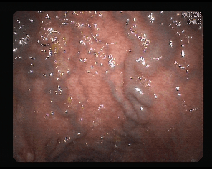 Varices Rectales.